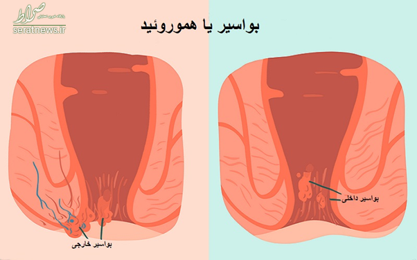 بواسیر چیست؟ درمان سریع بواسیر با لیزر