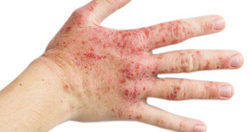 این بیماری خود ایمنی پوستی تمام بدنتان را درگیر می‌کند