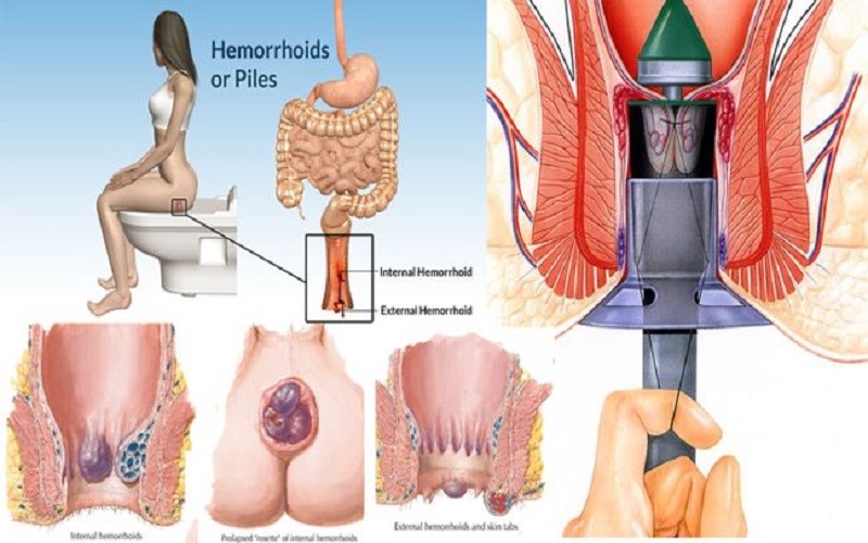 ۶ روش موثر درمان بيماري هموروئيد