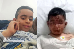 زخم آتش بر چهره قهرمان ۸ ساله/ پدر محمدطاها: توان پرداخت هزینه جراحی را ندارم