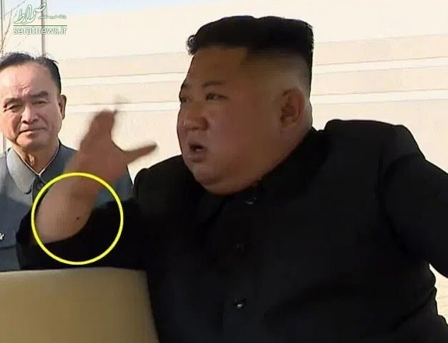 عکس/ راز جای سوزن روی دست رهبر کره شمالی چیست؟