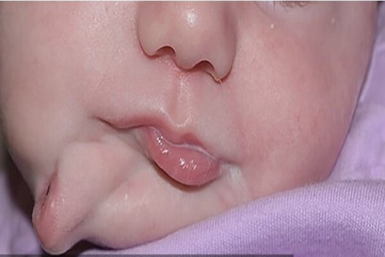 عکس/ نوزادی با دو دهان متولد شد!