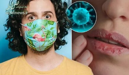 تغییرات عجیب لبها بر اثر ابتلا به ویروس کرونا + عکس تغییرات عجیب لبها بر اثر ابتلا به ویروس کرونا + عکس
