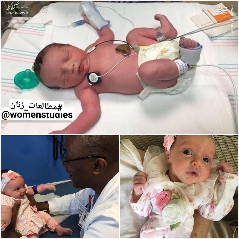 عکس/ نوزاد دختری که در آمریکا دوبار به دنیا آمد!