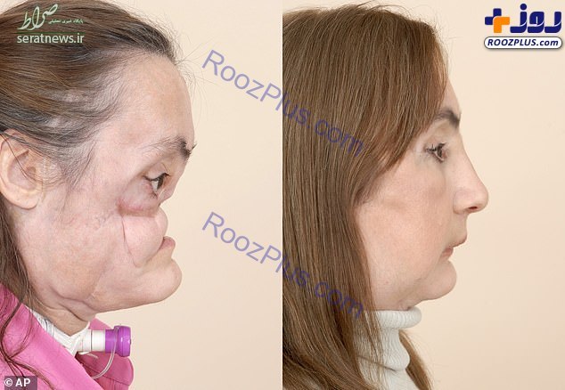 مرگ اولین زن جهان که صورت پیوندی داشت+عکس مرگ اولین زن جهان که صورت پیوندی داشت+عکس