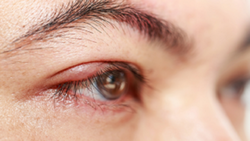 تشخیص سرطان پس از اسپری تصادفی ادکلن در چشم!