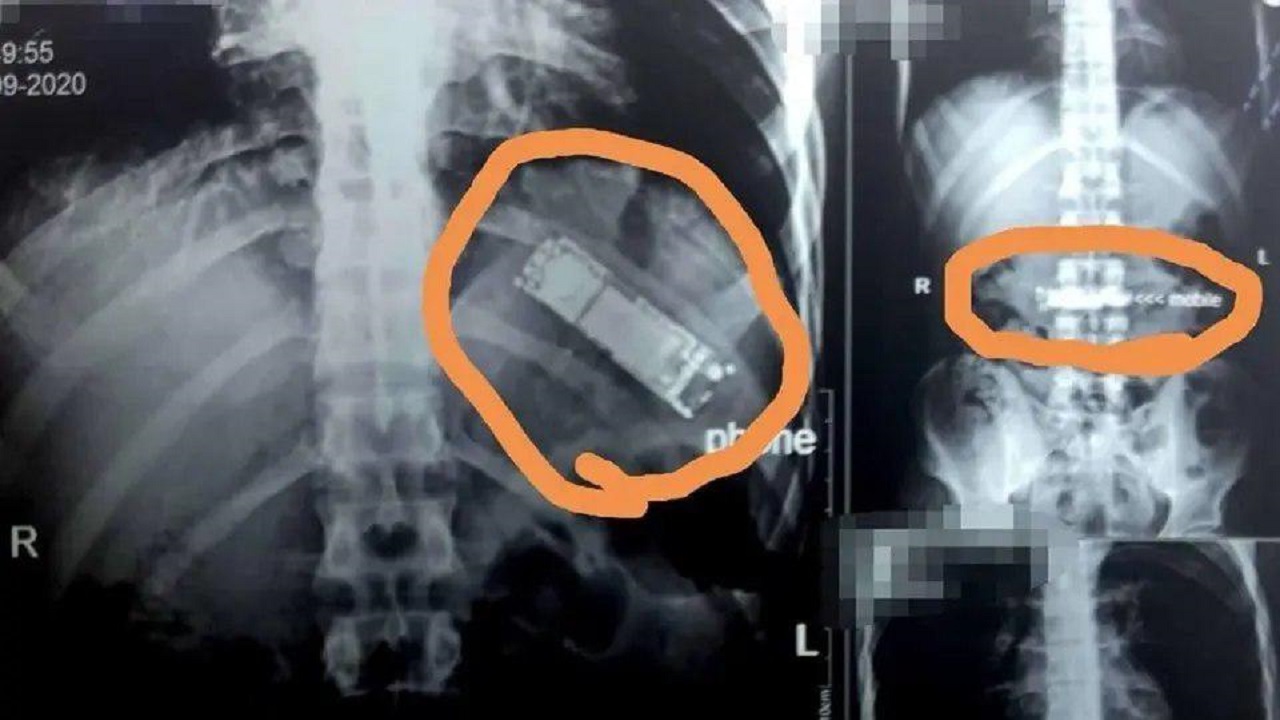 نجات یک بیمار از خطر انفجار معده! + عکس نجات یک بیمار از خطر انفجار معده! + عکس