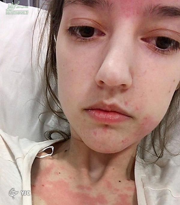 دختری با بیماری عجیب که غذا را از طریق قلبش می‌خورد + تصاویر