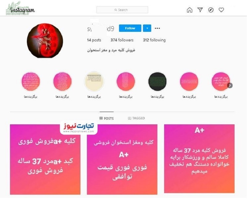 خرید و فروش اعضای بدن؛ کلیه ۱۵۰، نیمی از کبد ۲۰۰ میلیون تومان!+ عکس