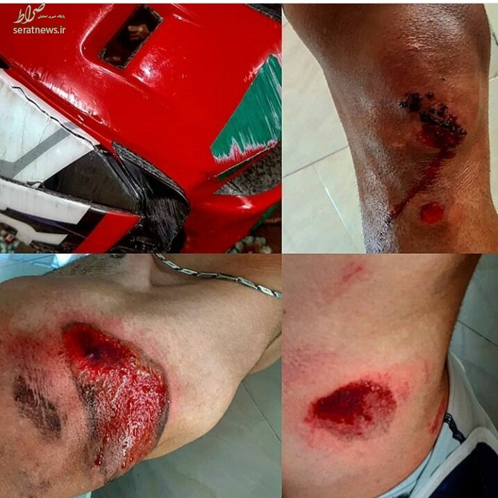 مصدومیت شدید قهرمان دوچرخه‌سواری ایران+عکس