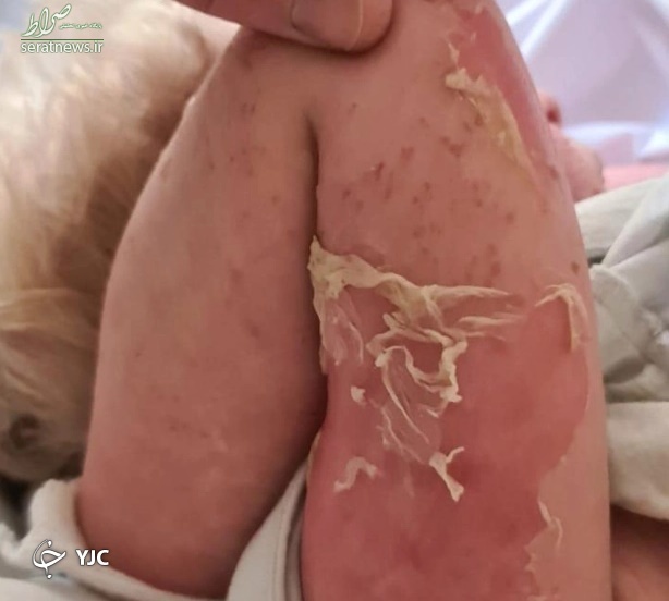 مشاهدات وحشتناک یک مادر از کنده شدن پوست پسرش بر اثر بیماری عجیب