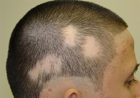 درمان انواع ریزش مو در کلینیک تخصصی پوست و مو رز