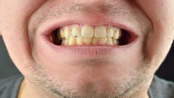 این عادت‌های غلط دندان‌های شما را زرد می‌کنند
