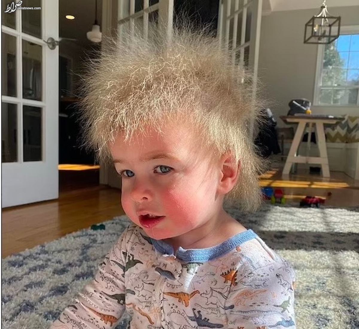 عکس / بیماری عجیب یک پسربچه؛ سندرم موی غوطه ور!