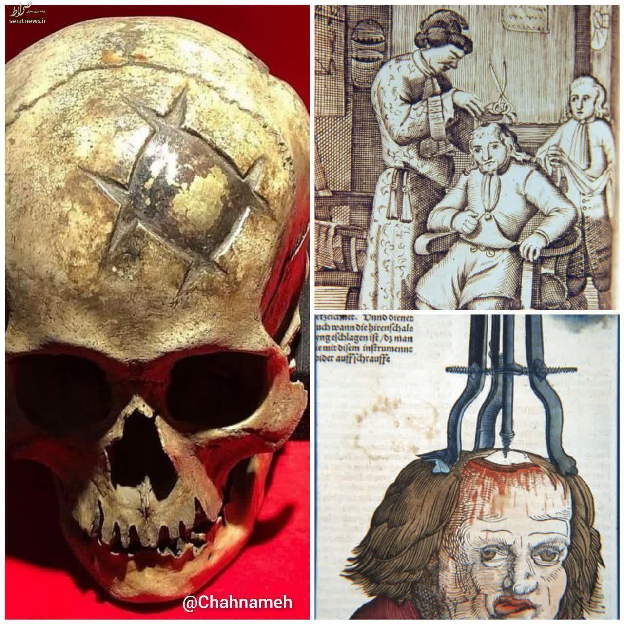 نمونه‌ای حیرت انگیز از جراحی جمجمه، ۱۶۰۰ سال پیش!