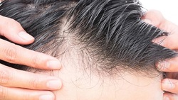 ریزش موی ناشی از ویروس کرونا دائمی نیست