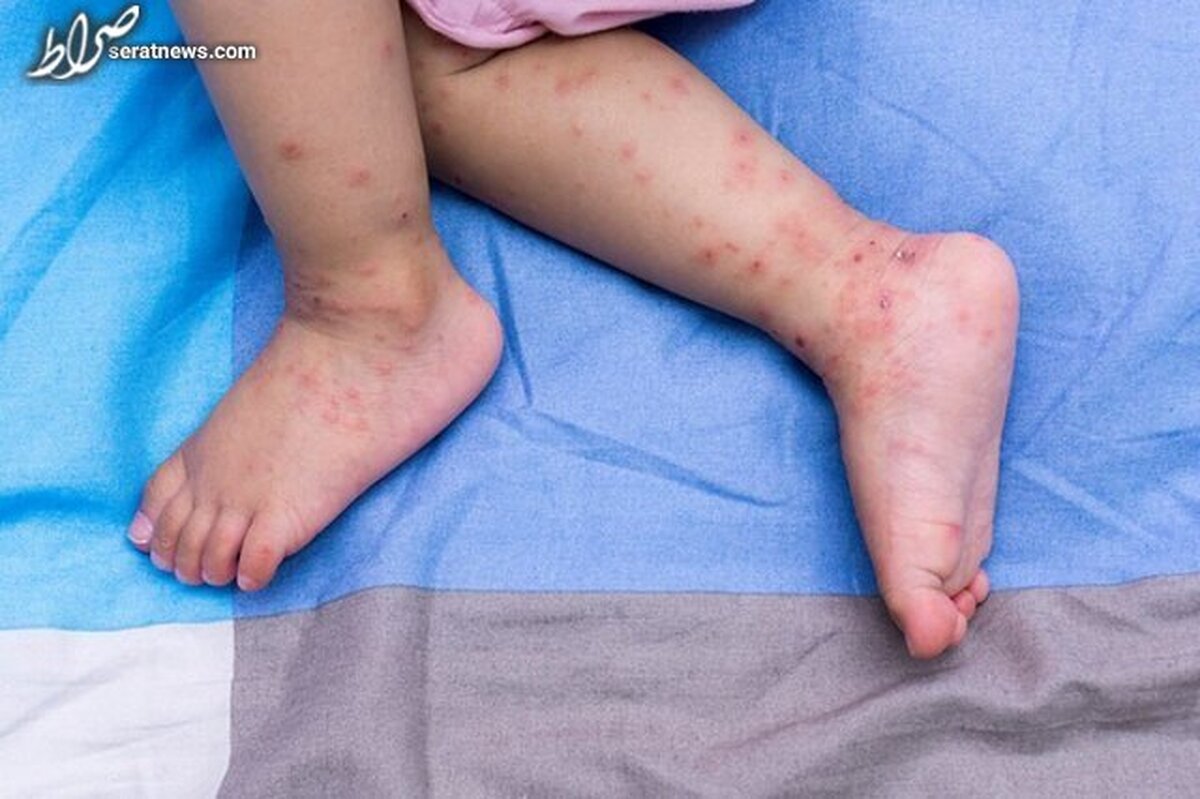 جزئیاتی درباره شیوع بیماری