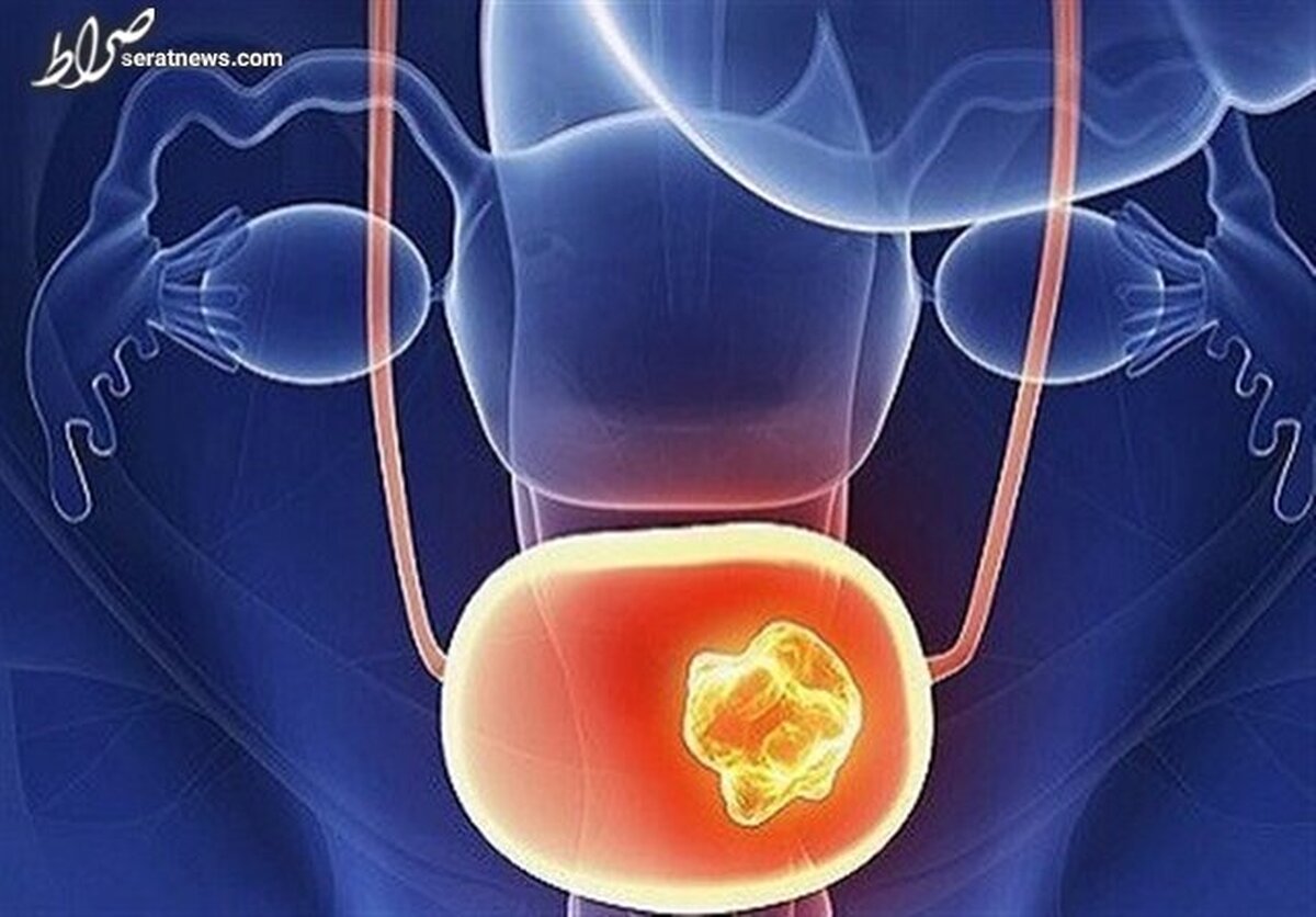 چرا دچار سنگ مثانه میشویم؟