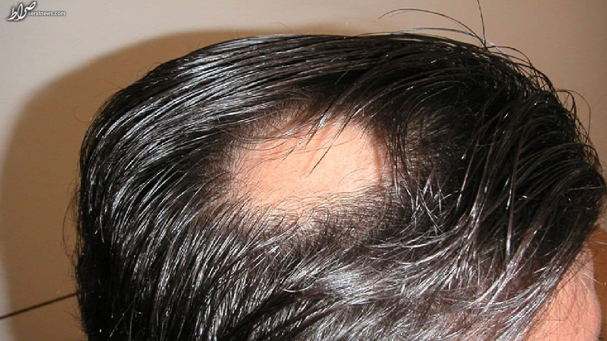 علت ریزش سکه‌ای مو چیست؟