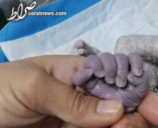 تولد نوزادی با ۲۴ انگشت در بغداد + عکس