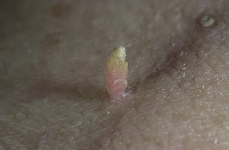 بهترین متخصص زگیل تناسلی برای درمان ویروس HPV کیست؟