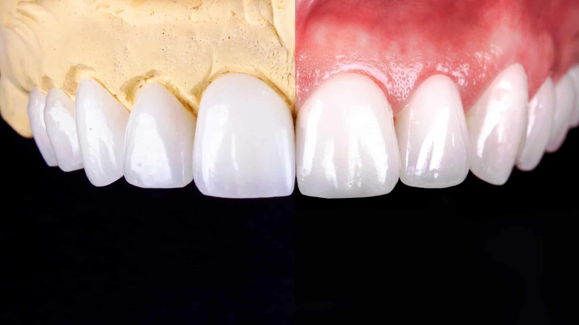 معایب کامپوزیت دندان چیست؟