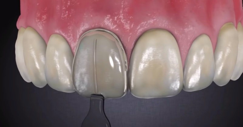معایب کامپوزیت دندان چیست؟