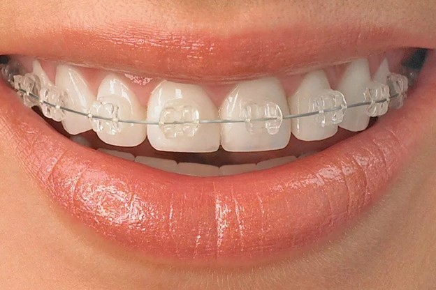 ارتودنسی دندان و نگهداری از آن