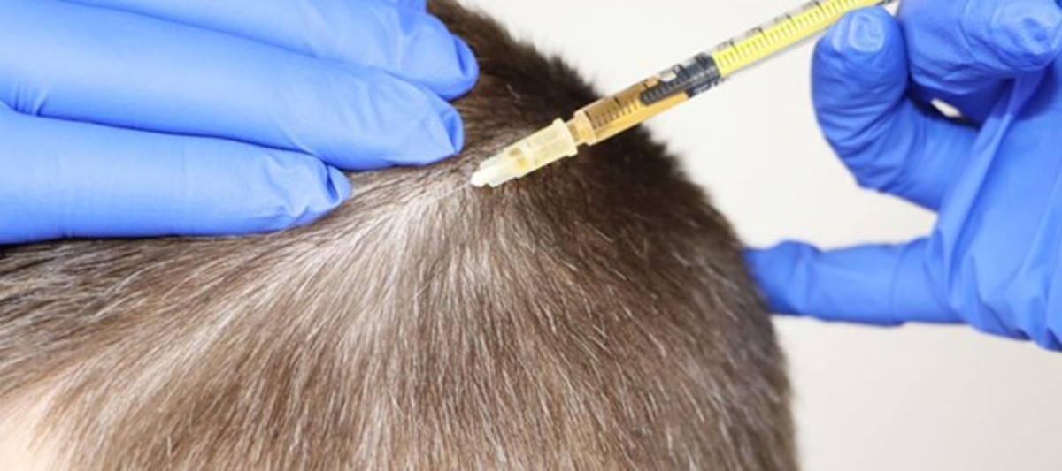 مزوتراپی مو چیست؟ چقدر تاثیر دارد؟