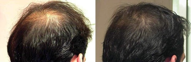 مزوتراپی مو چیست؟ چقدر تاثیر دارد؟