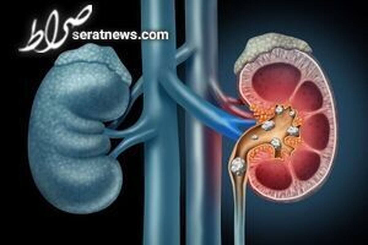 آب جوشیده شده باعث ایجاد سنگ کلیه می‌شود؟!