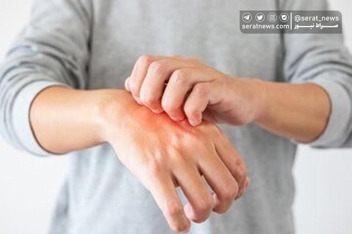 علائم هشدار دهنده این بیماری روی پوست