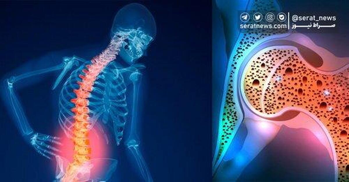 سهم بالای زنان در کمبود ویتامین D /سرانه پایین مصرف لبنیات در کشور