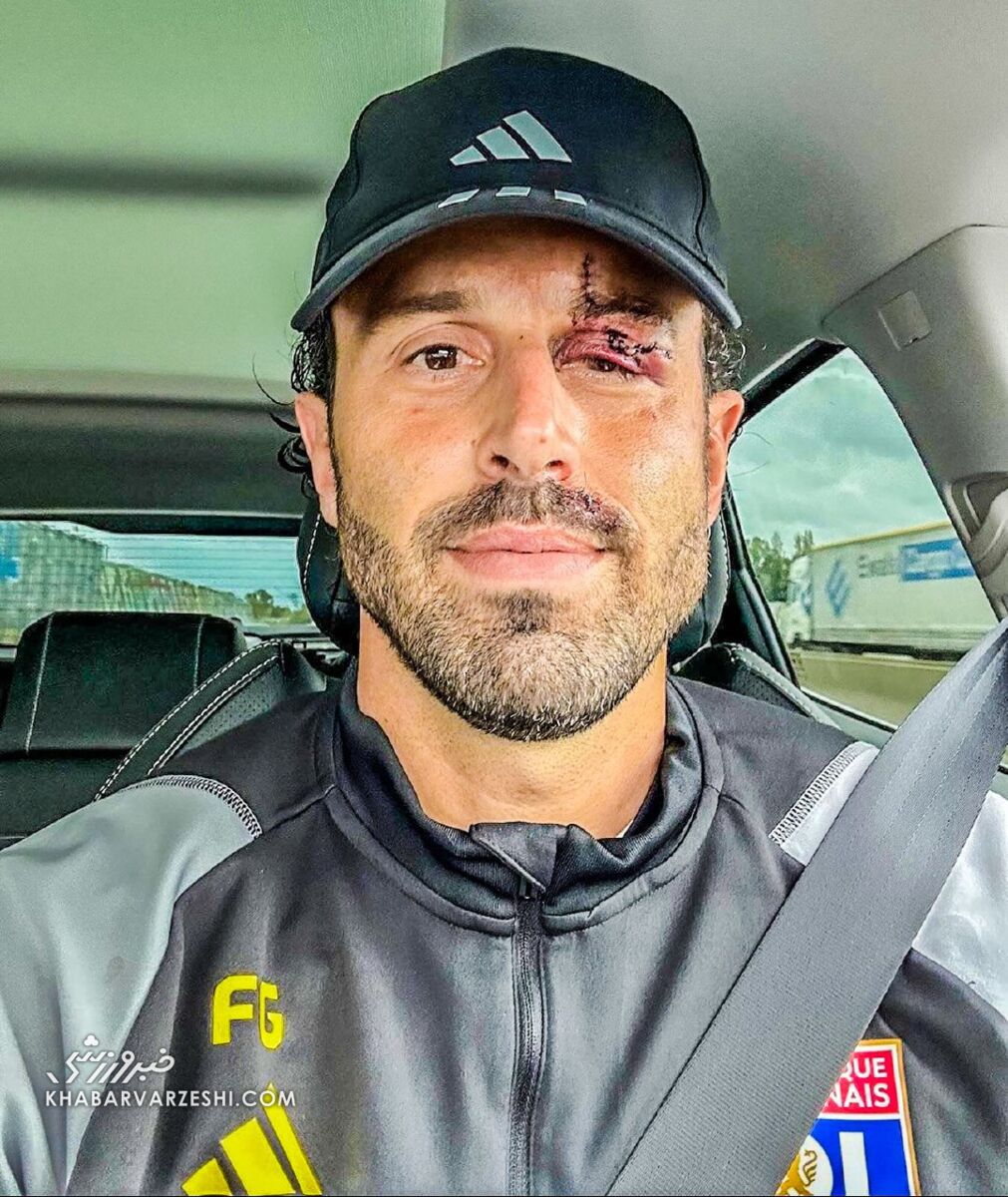 عکس| ۱۳ بخیه روی چشم سرمربی ایتالیایی/ صورت متلاشی شده یک روز پس از حمله خونین