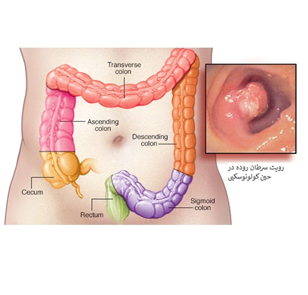 علت شیوع سرطان روده در بین جوانان چیست؟