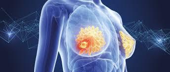 کلید تشخیص زودهنگام و درمان موفق سرطان سینه چیست؟