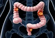 زنگ خطر سرطان روده بزرگ در ایران به صدا درآمد