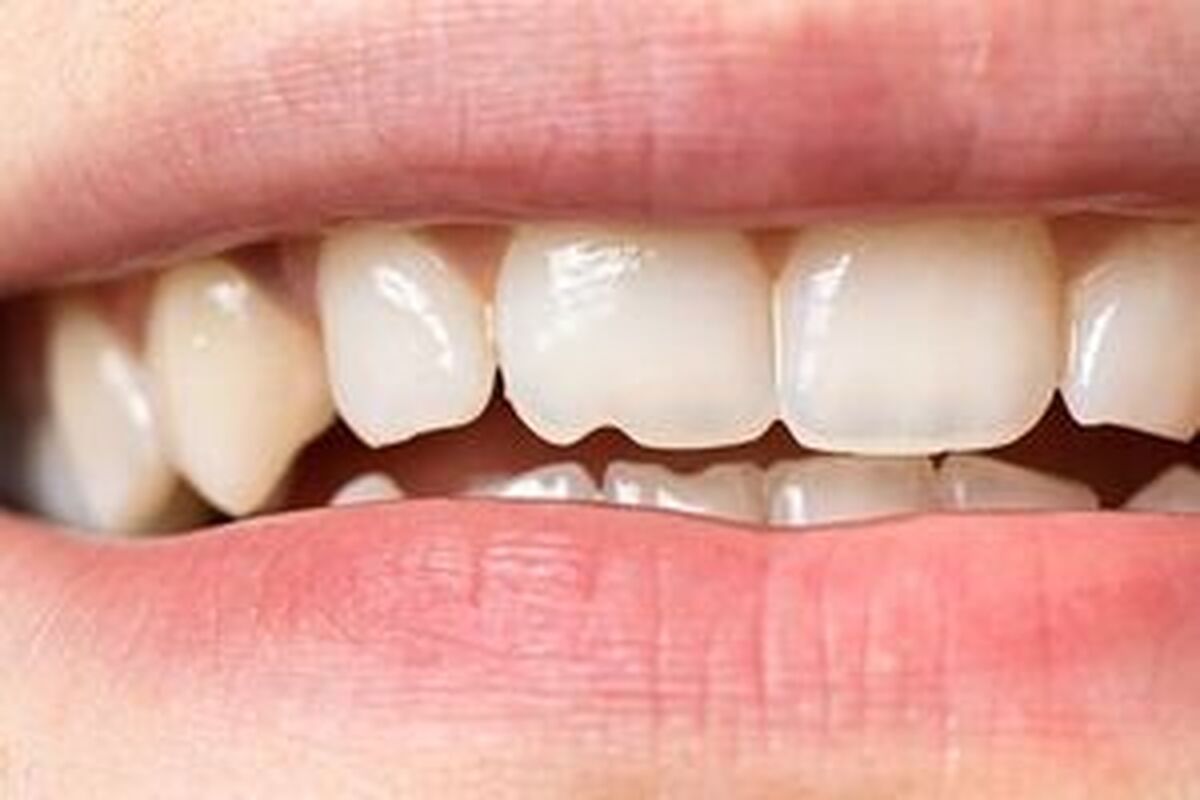 خوردن تخمه باعث فاصله افتادن بین دندان‌ها می‌شود؟