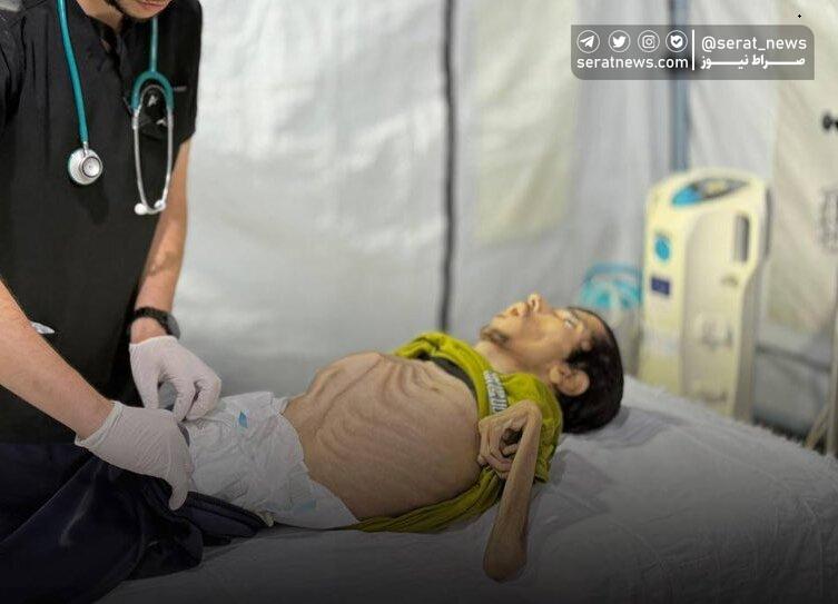 این تصاویر از پیکر شهید جوان فلسطینی جهان را تکان داد؛ ببینید | اسکلت استخوانی؛ توصیف رسانه ها از سوءتغذیه حاد ایوب