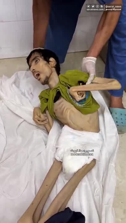 این تصاویر از پیکر شهید جوان فلسطینی جهان را تکان داد؛ ببینید | اسکلت استخوانی؛ توصیف رسانه ها از سوءتغذیه حاد ایوب