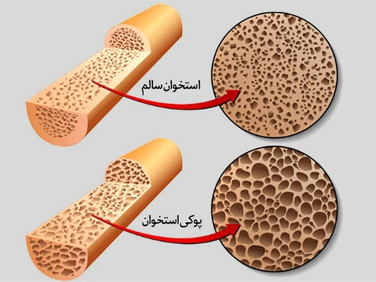 این خوراکی کوچک، دشمن بزرگ پوکی استخوان است
