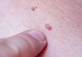هر آنچه باید درباره بیماری HPV بدانید