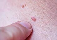 هر آنچه باید درباره بیماری HPV بدانید