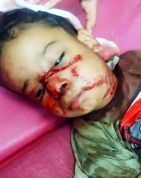 حمله سگ‌های بدون‌صاحب به کودک ۴ ساله + عکس