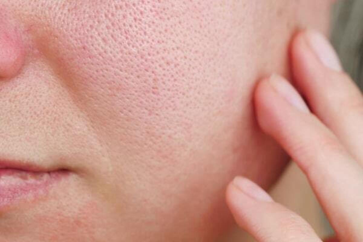 راهکاری برای منافذ باز پوست