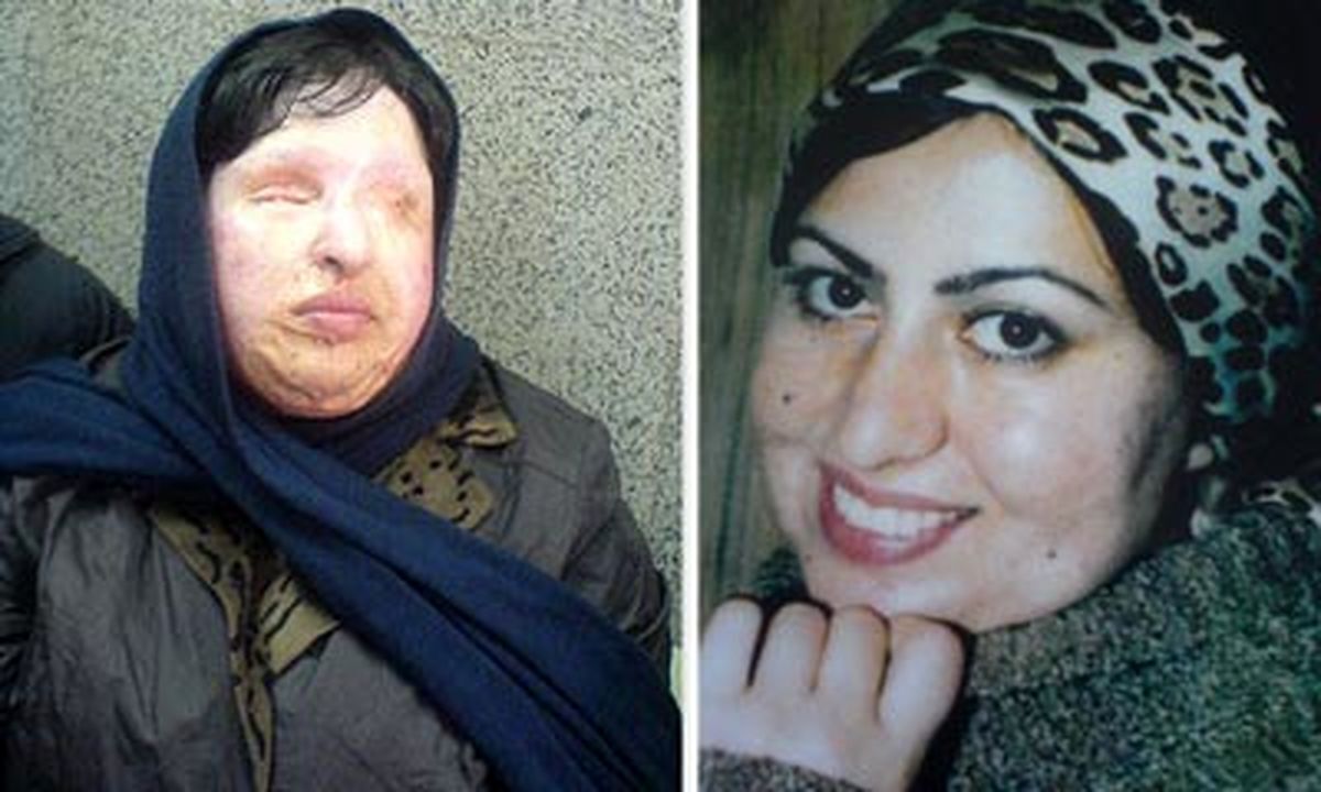 فیلم| چگونه خواستگار اسیدپاش زندگی آمنه بهرامی را نابود کرد؟