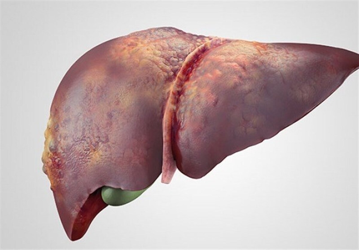 این موارد به کبدتان آسیب می‌زنند