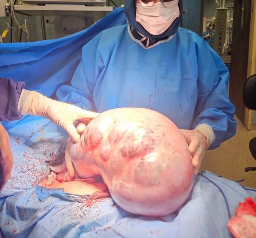 خارج‌ کردن توده ۱۰ کیلویی از شکم یک بیمار + عکس