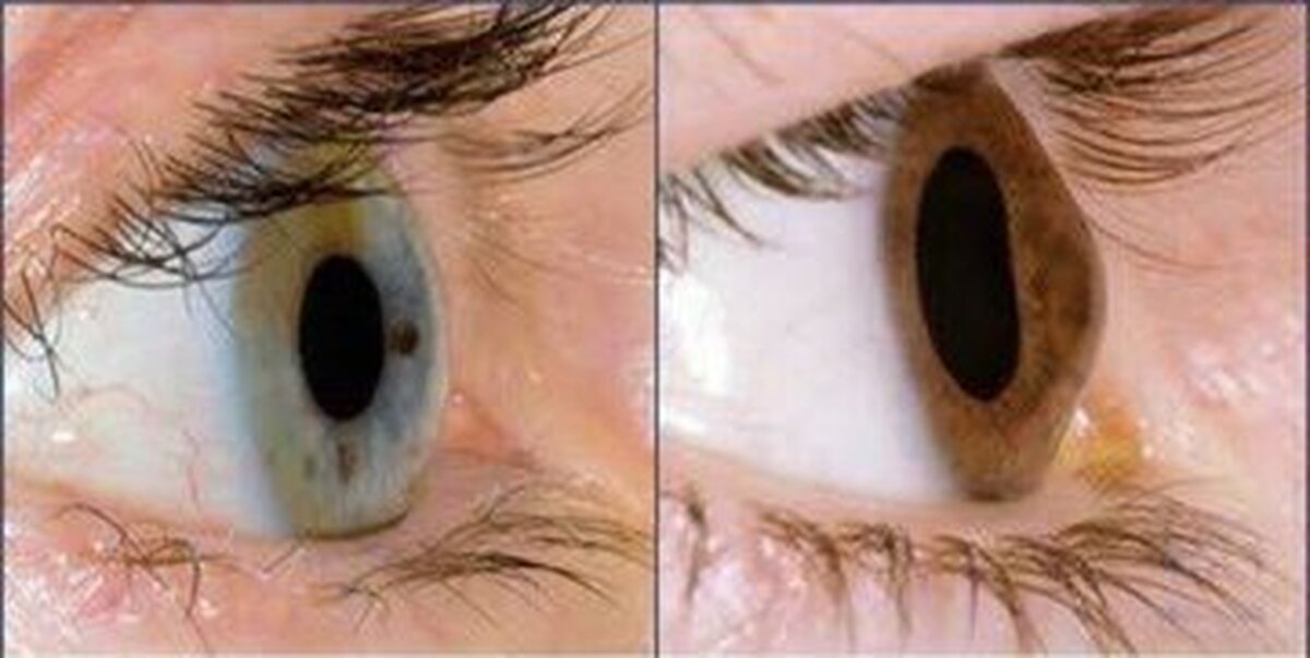 آیا استفاده مداوم از موبایل و لپ‌تاپ باعث قوز قرنیه می‌شود؟