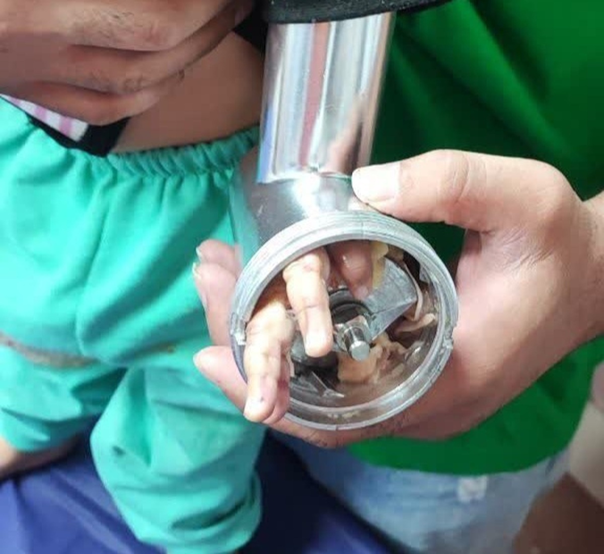مجروح شدن دست کودک 1.5 ساله بر اثر گیر کردن در چرخ‌گوشت